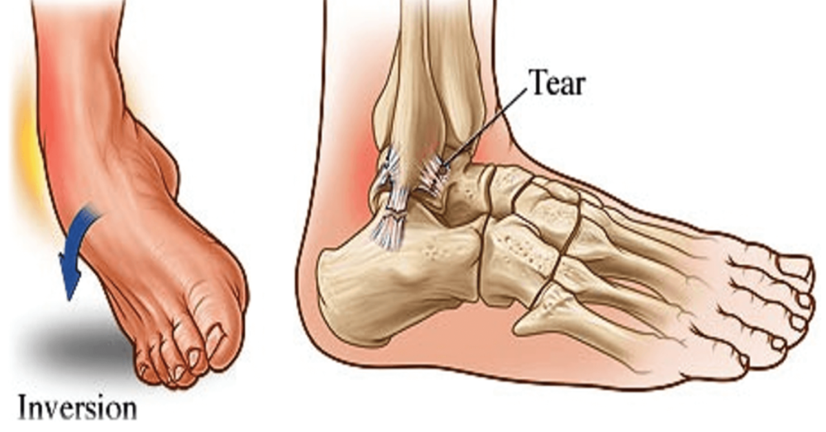 Foot and Ankle Injuries: When to Seek Specialist Care