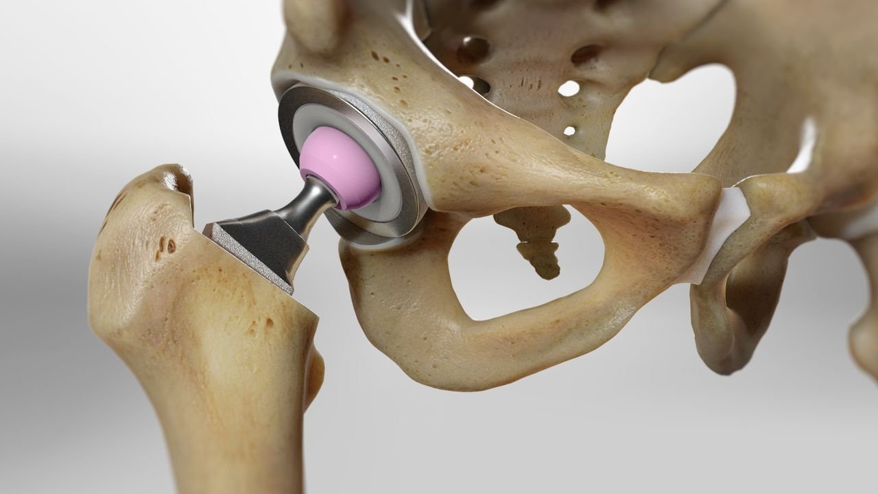 Knee implant specialist in delhi