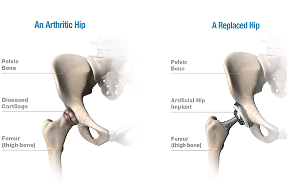 hip arthritis treatment in Delhi