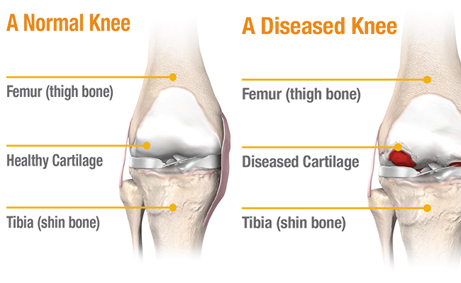 Dr Aman Dua explains about various treatment options for Knee Arthritis including non-operative methods and Knee Replacement Surgery